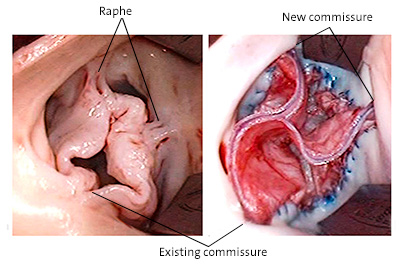 Operative view of pre- and post-tricuspid repair of unicuspid aortic valve 